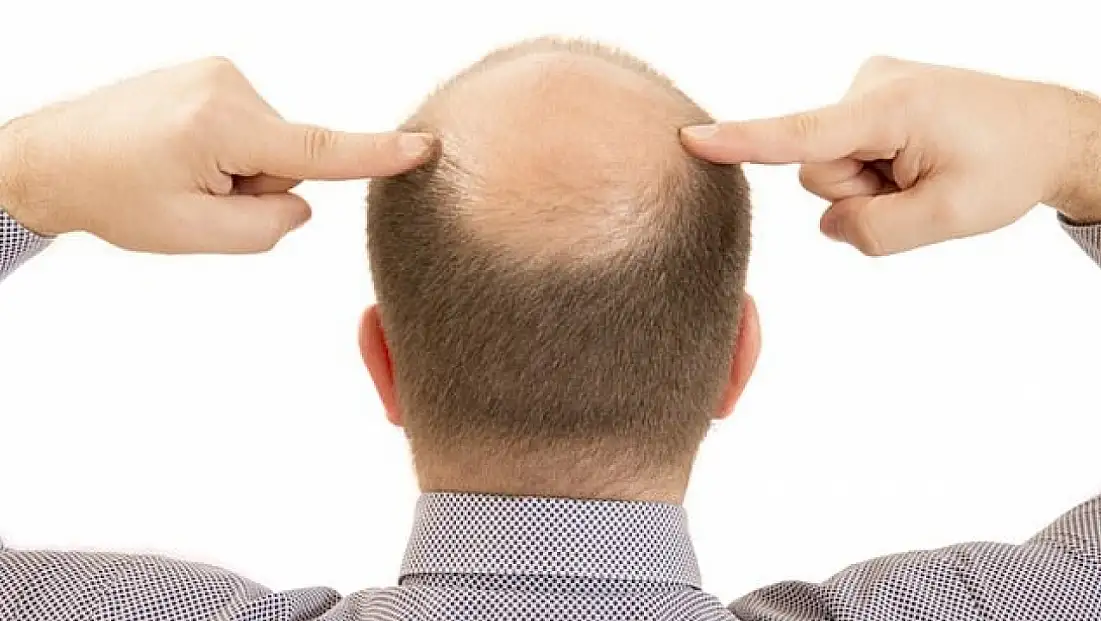 Bilim İnsanlarından Çarpıcı Keşif: Saç Dökülmesi 20 Günde Tedavi Edilebilecek! Kellik Tarih mi oluyor?