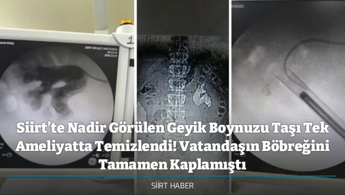Siirt’te Nadir Görülen Geyik Boynuzu Taşı Tek Ameliyatta Temizlendi! Vatandaşın Böbreğini Tamamen Kaplamıştı