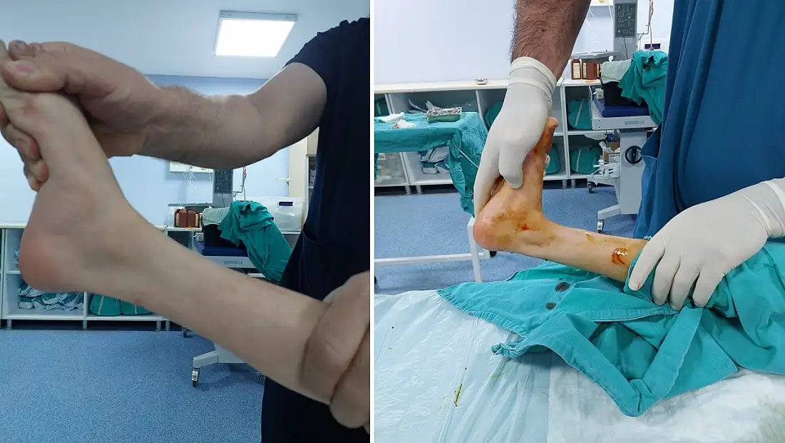 Özel Siirt Hayat Hastanesinde Bir İlk: Parmak Ucu Yürüme Ameliyatı Başarıyla Gerçekleştirildi