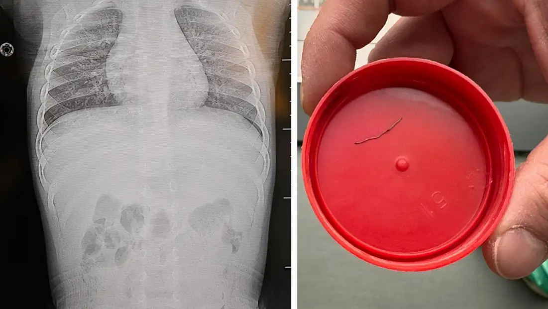 Sırtüstü yatırılan bebek hep ağladı, gerçeği öğrenen aile donup kaldı