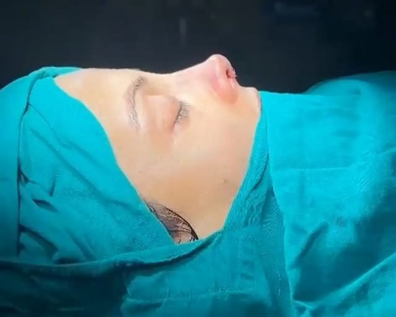 Siirt'te Septal Perforasyon Onarımı ve Revizyon Rinoplasti Ameliyatı Başarıyla Yapıldı