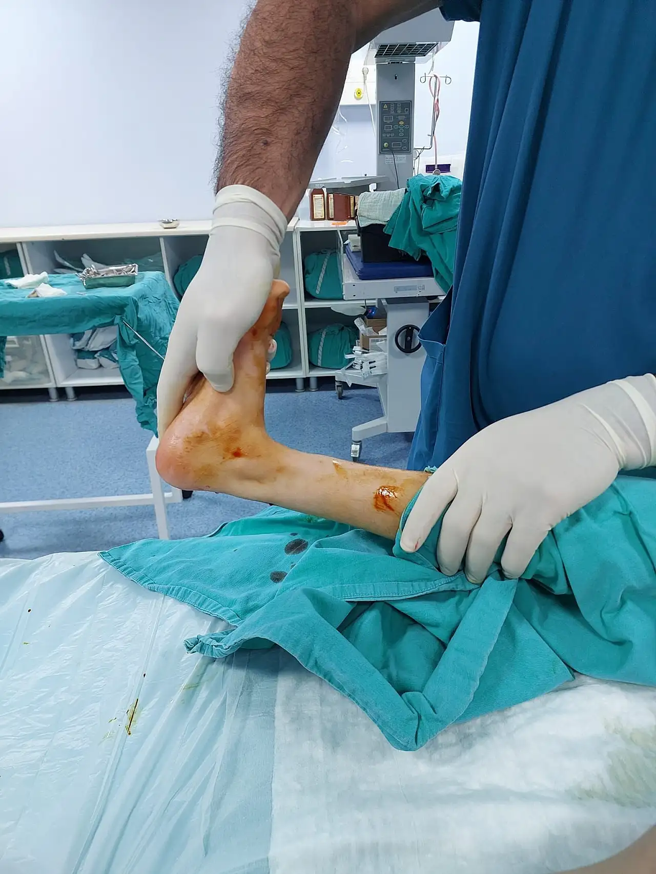 Özel Siirt Hayat Hastanesinde Bir İlk: Parmak Ucu Yürüme Ameliyatı Başarıyla Gerçekleştirildi