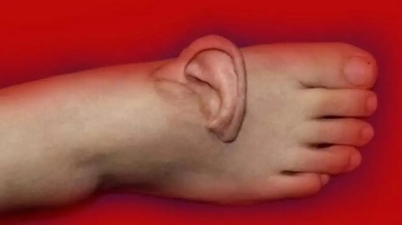 Eşi benzeri görülmemiş operasyon! Kulağını 5 ay boyunca ayağında taşıdı