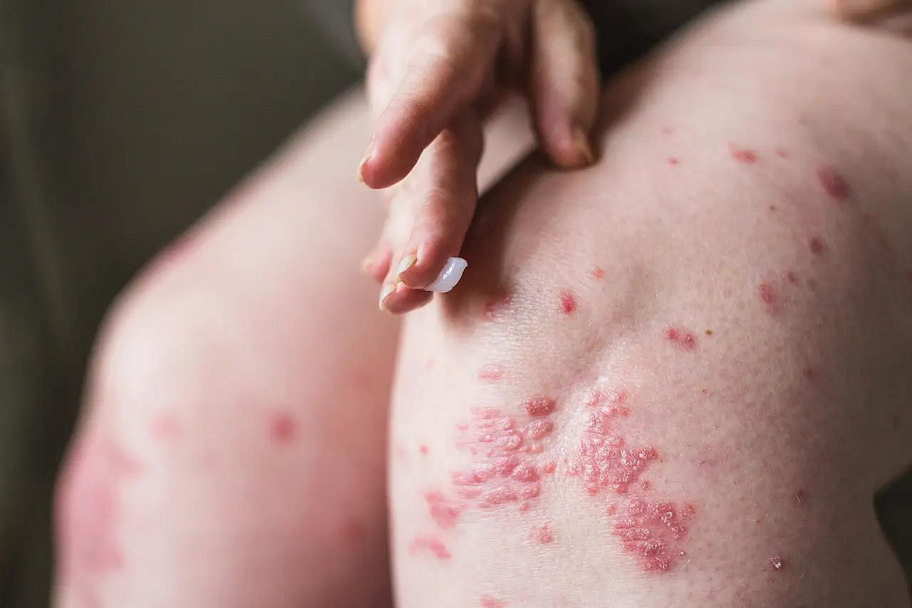 Siirt EAH Dermatoloji Uzmanı Dr. Ecem Kaya'dan 50 Yaş Üstüne Kritik Mesaj