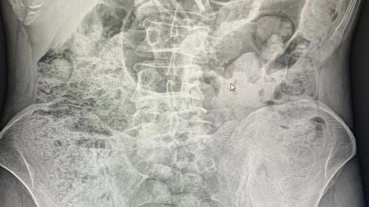 Siirt'te Emniyetten Filmleri Aratmayan Operasyon: Midelerinden 119 Paket Uyuşturucu Çıkarıldı! Ameliyattan Sonra 4 Kişi Tutuklandı