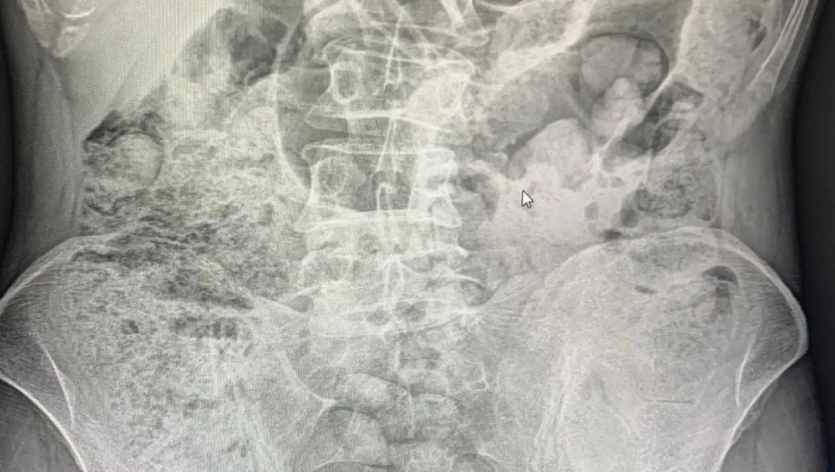 Siirt'te Emniyetten Filmleri Aratmayan Operasyon: Midelerinden 119 Paket Uyuşturucu Çıkarıldı! Ameliyattan Sonra 4 Kişi Tutuklandı