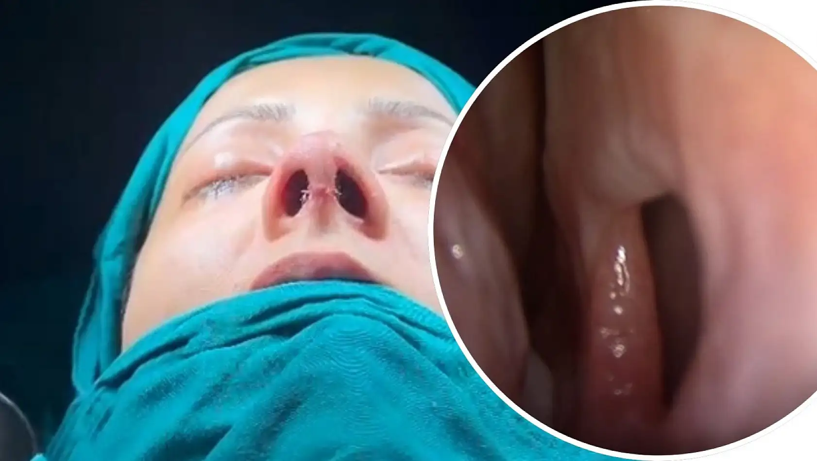 Siirt'te Septal Perforasyon Onarımı ve Revizyon Rinoplasti Ameliyatı Başarıyla Yapıldı