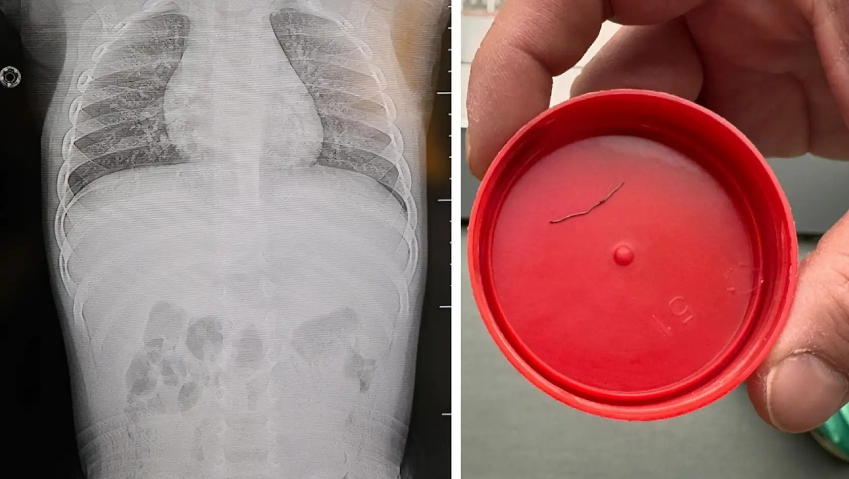 Sırtüstü yatırılan bebek hep ağladı, gerçeği öğrenen aile donup kaldı