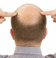 Bilim İnsanlarından Çarpıcı Keşif: Saç Dökülmesi 20 Günde Tedavi Edilebilecek! Kellik Tarih mi oluyor?