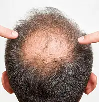 Saç Dökülmesine Karşı Antik Bitkiden Bilimsel Umut: Kellik İçin Yeni Bir Dönem Başlayabilir