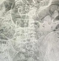 Siirt'te Emniyetten Filmleri Aratmayan Operasyon: Midelerinden 119 Paket Uyuşturucu Çıkarıldı! Ameliyattan Sonra 4 Kişi Tutuklandı