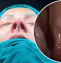 Siirt'te Septal Perforasyon Onarımı ve Revizyon Rinoplasti Ameliyatı Başarıyla Yapıldı