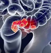 Vücudunuz Sinyal Veriyor: Kolorektal Kanserin Gizli Belirtileri