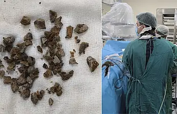 Op. Dr. Miraç Ataman'dan Siirt'te Başarılı Operasyon: Dev Böbrek Taşı Kapalı Yöntemle Çıkarıldı