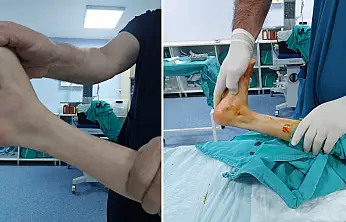 Özel Siirt Hayat Hastanesinde Bir İlk: Parmak Ucu Yürüme Ameliyatı Başarıyla Gerçekleştirildi