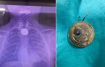 Siirt'te boğazına madeni para kaçan çocuk, başarılı operasyonla kurtarıldı