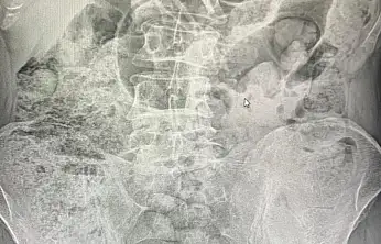 Siirt'te Emniyetten Filmleri Aratmayan Operasyon: Midelerinden 119 Paket Uyuşturucu Çıkarıldı! Ameliyattan Sonra 4 Kişi Tutuklandı