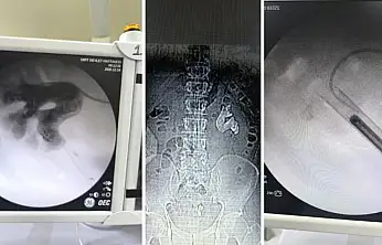 Siirt'te Nadir Görülen Geyik Boynuzu Taşı Tek Ameliyatta Temizlendi! Vatandaşın Böbreğini Tamamen Kaplamıştı