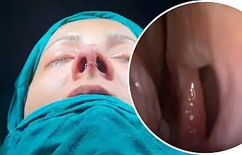 Siirt'te Septal Perforasyon Onarımı ve Revizyon Rinoplasti Ameliyatı Başarıyla Yapıldı