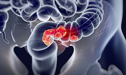 Vücudunuz Sinyal Veriyor: Kolorektal Kanserin Gizli Belirtileri