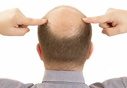 Bilim İnsanlarından Çarpıcı Keşif: Saç Dökülmesi 20 Günde Tedavi Edilebilecek! Kellik Tarih mi oluyor?