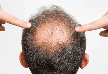 Saç Dökülmesine Karşı Antik Bitkiden Bilimsel Umut: Kellik İçin Yeni Bir Dönem Başlayabilir