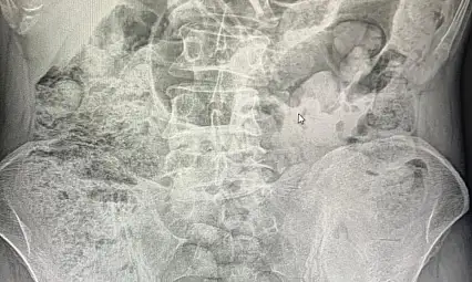 Siirt'te Emniyetten Filmleri Aratmayan Operasyon: Midelerinden 119 Paket Uyuşturucu Çıkarıldı! Ameliyattan Sonra 4 Kişi Tutuklandı