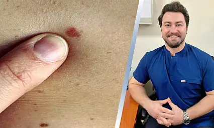 Siirt'te Sıkça Görülen Deri Kanseri Uyarısı: Uzm. Dr. Aslankoç'tan Önemli Uyarılar