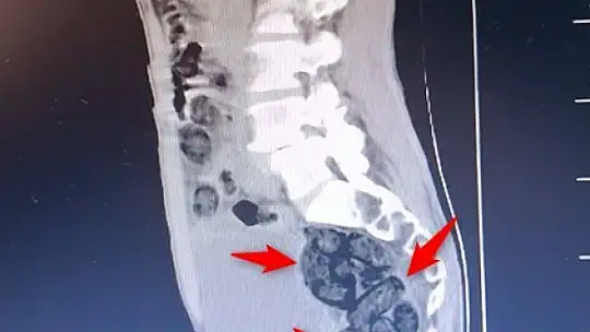 Batman'da yabancı uyruklu bir  şahsın midesinden 64 parça uyuşturucu çıktı