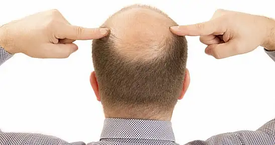 Bilim İnsanlarından Çarpıcı Keşif: Saç Dökülmesi 20 Günde Tedavi Edilebilecek! Kellik Tarih mi oluyor?