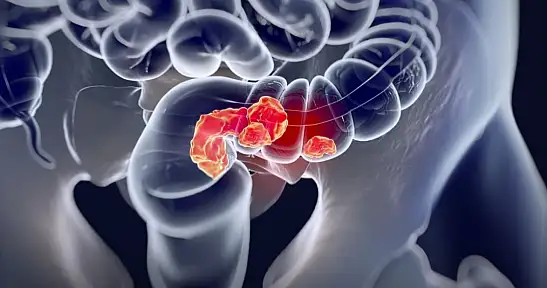 Vücudunuz Sinyal Veriyor: Kolorektal Kanserin Gizli Belirtileri