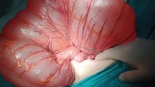 77 Yaşındaki Hasta, Siirt Hayat Hastanesinde Şifa Buldu