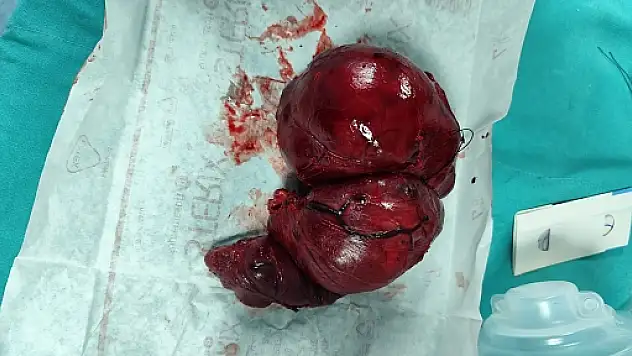 Doç. Dr. Akın Önder'den Başarılı Dev Guatr Ameliyatı