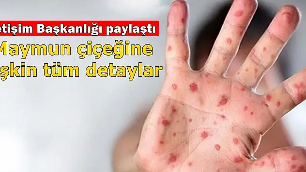 'Maymun Çiçeği' Türkiye'ye Girdi mi, Yaygın Şekilde Bulaşma Riski Var mı!