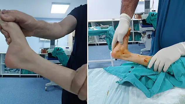 Özel Siirt Hayat Hastanesinde Bir İlk: Parmak Ucu Yürüme Ameliyatı Başarıyla Gerçekleştirildi