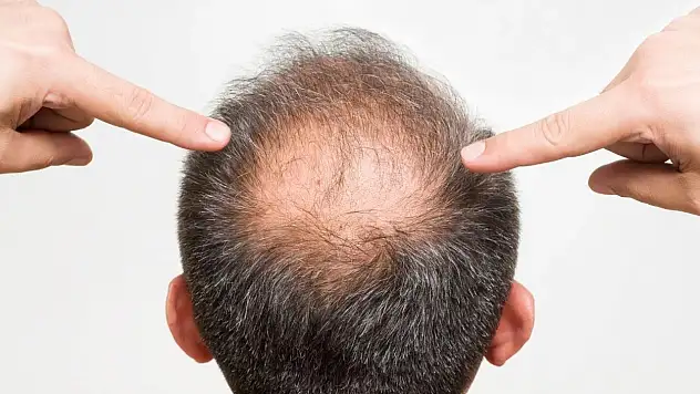 Saç Dökülmesine Karşı Antik Bitkiden Bilimsel Umut: Kellik İçin Yeni Bir Dönem Başlayabilir