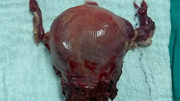 Siirt Hayat Hastanesinde Başarılı Ameliyatlar Devam Ediyor