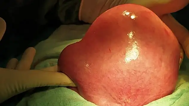 Siirt Hayat Hastanesinde Dev Miyom Ameliyatı Yapıldı