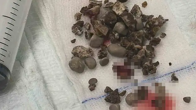 Siirt'te Böbreği Tamamen Kaplayan Taşlar Kapalı Ameliyatla Temizlendi