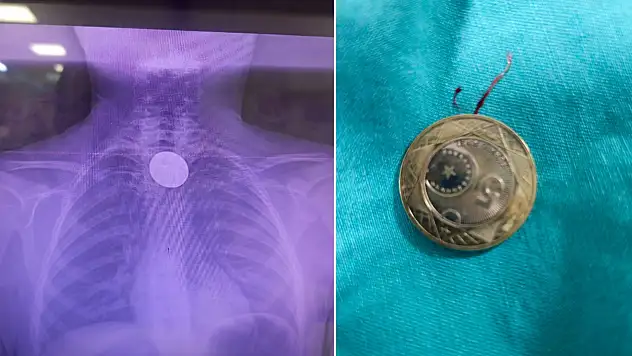 Siirt'te boğazına madeni para kaçan çocuk, başarılı operasyonla kurtarıldı