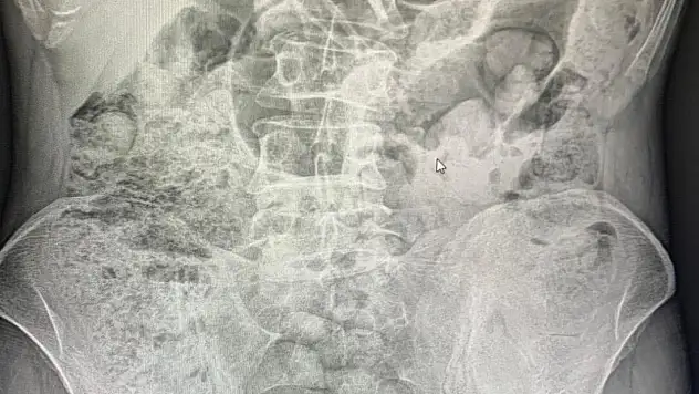 Siirt'te Emniyetten Filmleri Aratmayan Operasyon: Midelerinden 119 Paket Uyuşturucu Çıkarıldı! Ameliyattan Sonra 4 Kişi Tutuklandı