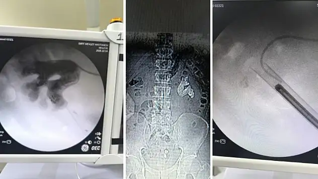 Siirt'te Nadir Görülen Geyik Boynuzu Taşı Tek Ameliyatta Temizlendi! Vatandaşın Böbreğini Tamamen Kaplamıştı