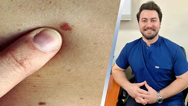 Siirt'te Sıkça Görülen Deri Kanseri Uyarısı: Uzm. Dr. Aslankoç'tan Önemli Uyarılar