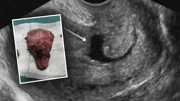 Siirt'te Başarılı Ameliyat