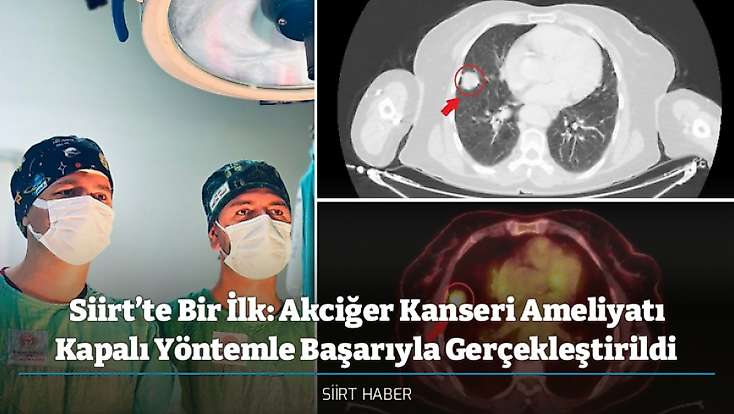 Siirt’te Bir İlk: Akciğer Kanseri Ameliyatı Kapalı Yöntemle Başarıyla Gerçekleştirildi