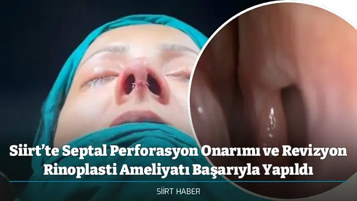 Siirt’te Septal Perforasyon Onarımı ve Revizyon Rinoplasti Ameliyatı Başarıyla Yapıldı