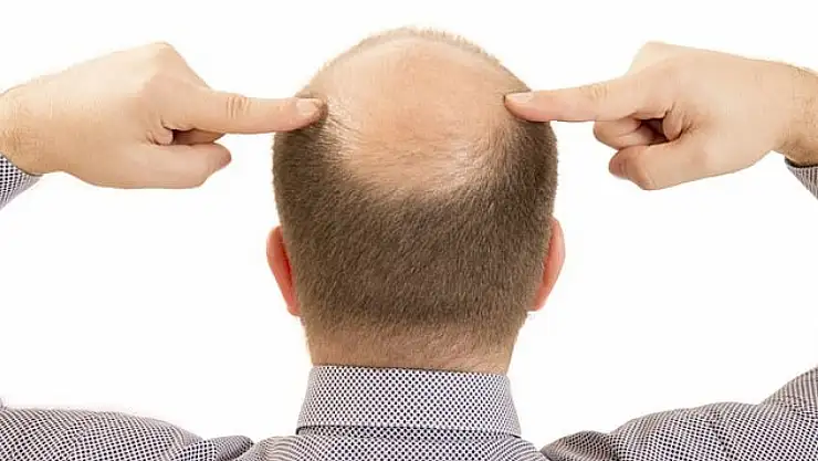 Bilim İnsanlarından Çarpıcı Keşif: Saç Dökülmesi 20 Günde Tedavi Edilebilecek! Kellik Tarih mi oluyor?