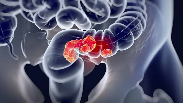 Vücudunuz Sinyal Veriyor: Kolorektal Kanserin Gizli Belirtileri