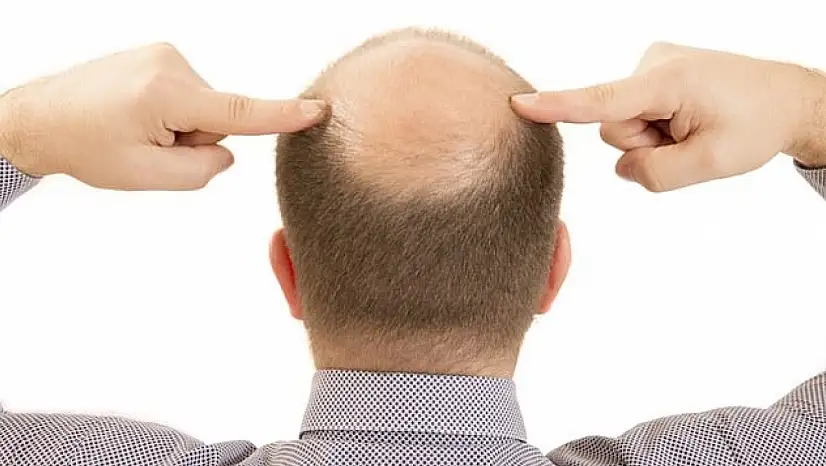 Bilim İnsanlarından Çarpıcı Keşif: Saç Dökülmesi 20 Günde Tedavi Edilebilecek! Kellik Tarih mi oluyor?