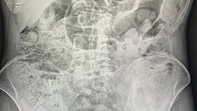 Siirt'te Emniyetten Filmleri Aratmayan Operasyon: Midelerinden 119 Paket Uyuşturucu Çıkarıldı! Ameliyattan Sonra 4 Kişi Tutuklandı